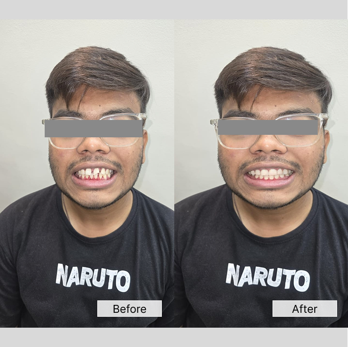 before/after